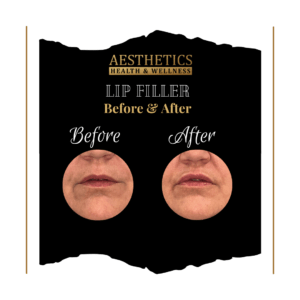 Lip Fillers Before & After (4123)