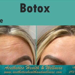 Botox Before and After