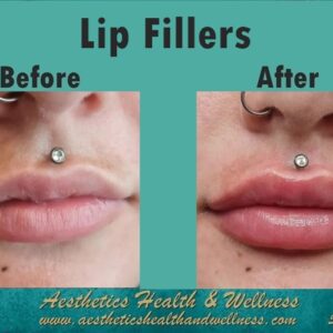 Lip fillers